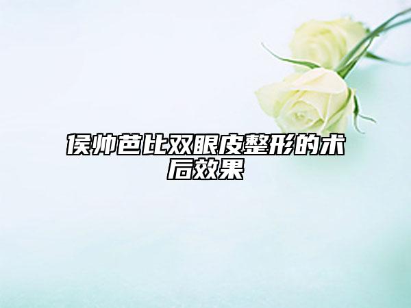 侯帥芭比雙眼皮整形的術(shù)后效果